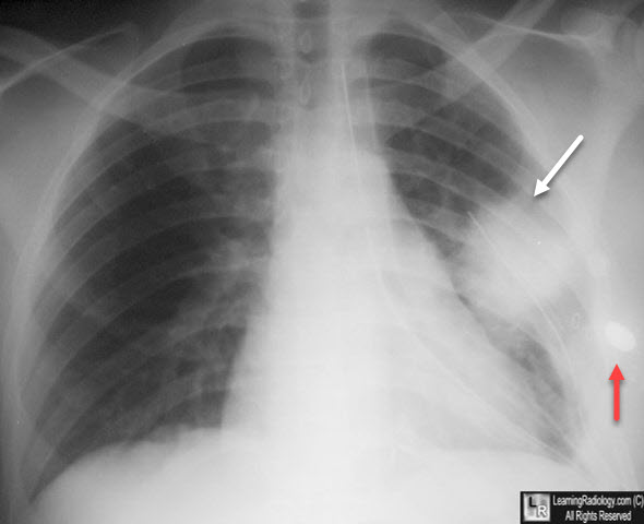 Pulmonary laceration